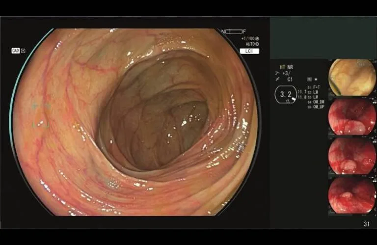 Fujifilm-Cad-Eye-AI-powered-endoscopy